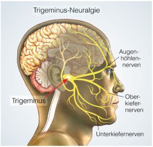 Anatomie der Trigeminusneuralgie